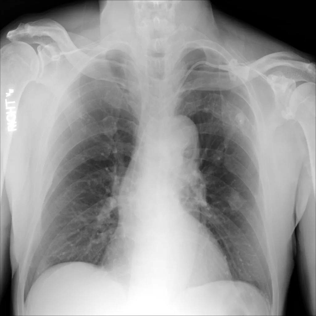 Chest radiograph with a radiologist-annotated pulmonary nodule in the left upper lung.