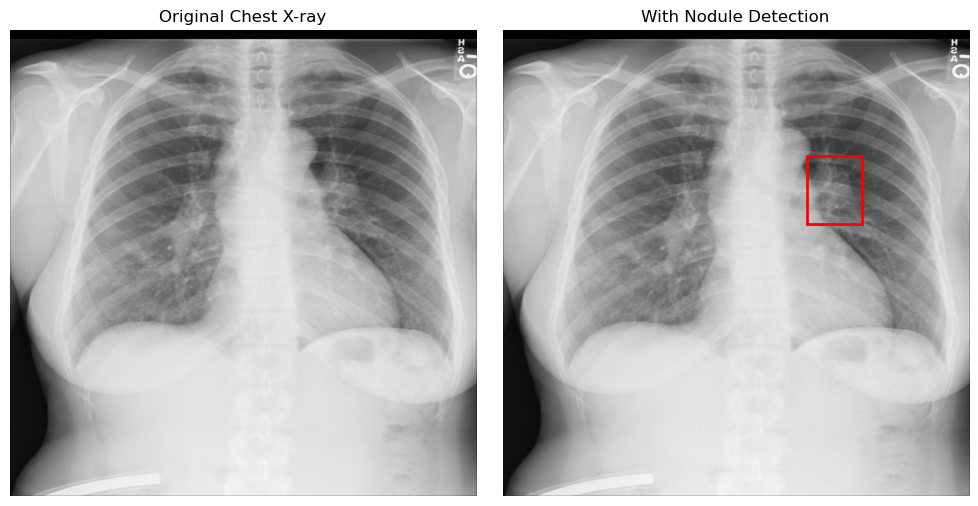 Nodule